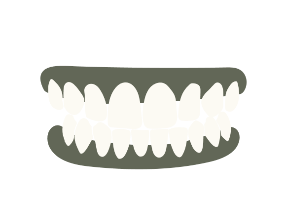 Crossbite