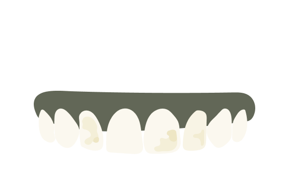 Discoloured Teeth