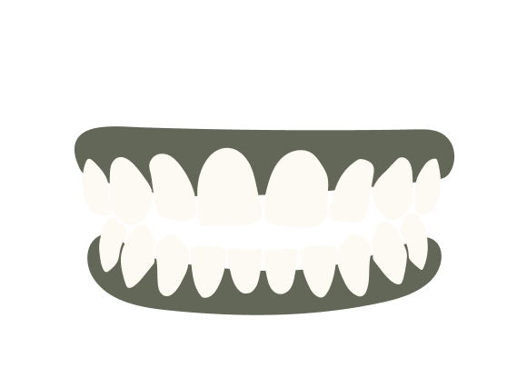 Open Bite