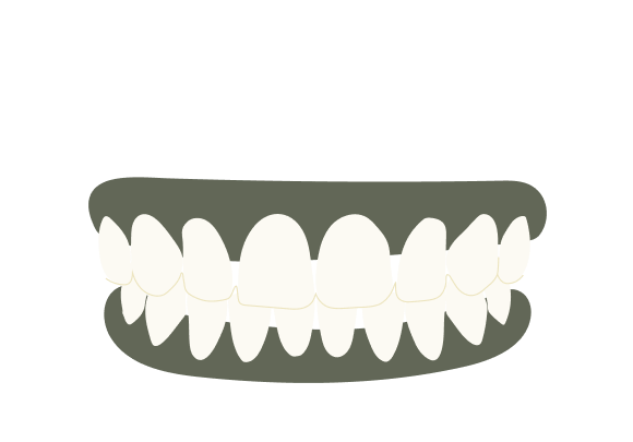 Overbite