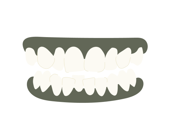 Overcrowded Teeth