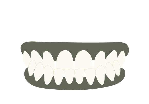 Underbite