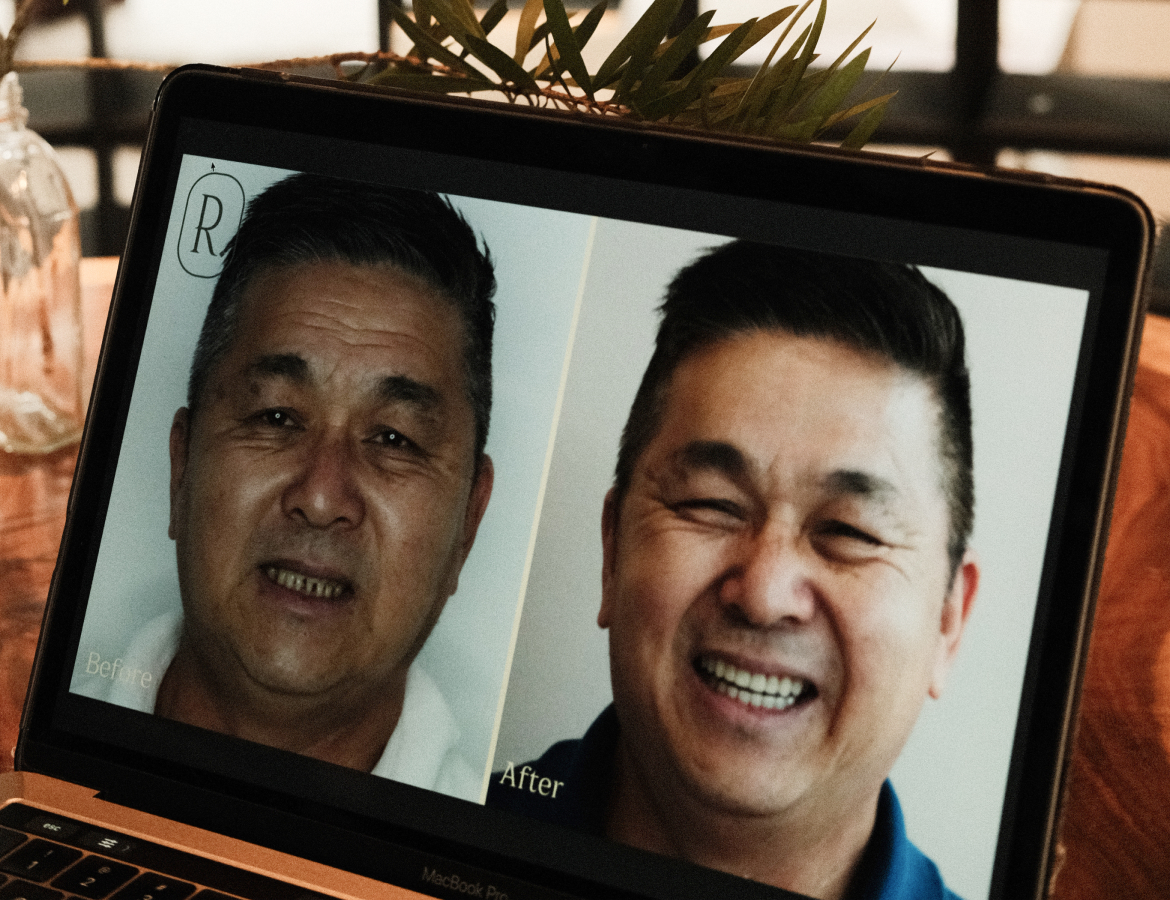 Porcelain Veneers Consultation 