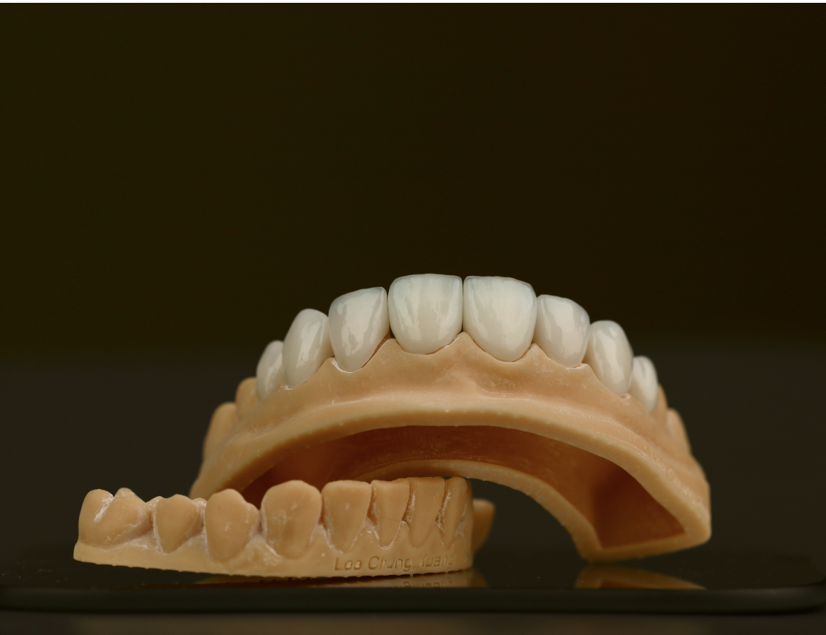 Reshaping Teeth Surface and Veneers Bonding